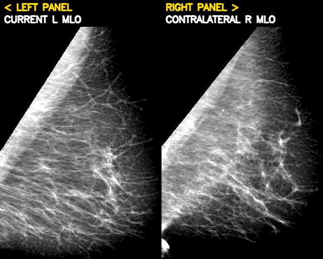 Contralateral breast example