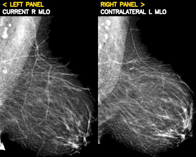 Contralateral comparison
