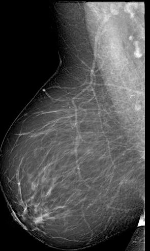 Input mammogram